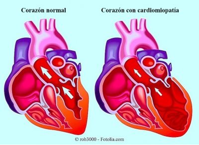 cardiopatía dilatada