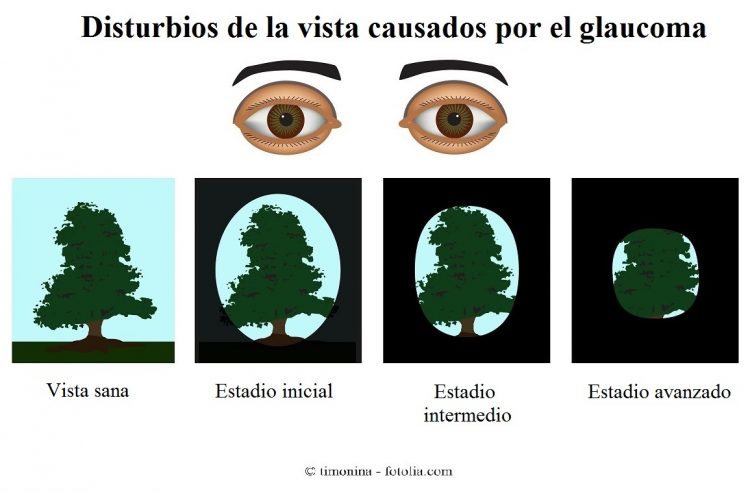 glaucoma, pérdida de la visión periférica