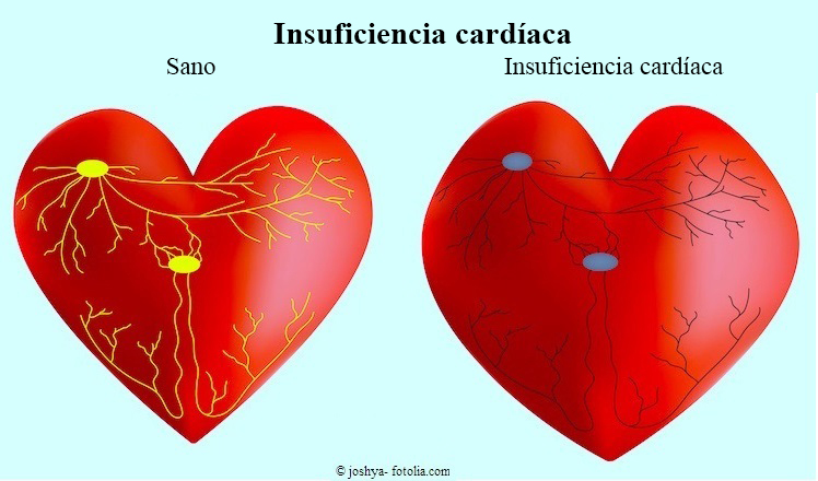 insuficiencia cardíaca, corazón