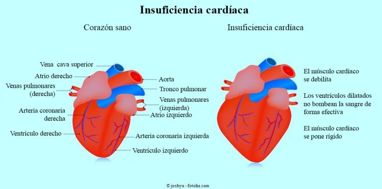insuficiencia cardíaca