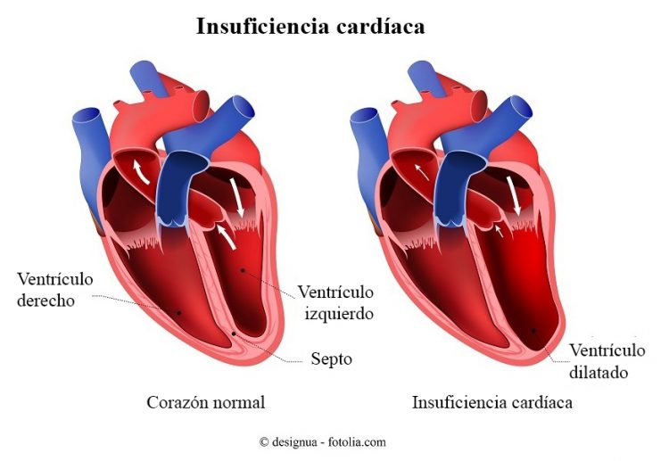 insuficiencia cardíaca, ventrículo dilatado