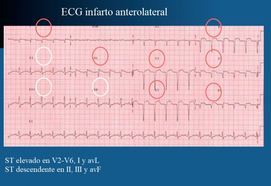 Infarto Agudo De Miocardio Ecg Diagn Stico Inferior Enzimas Y Elevacion Del St
