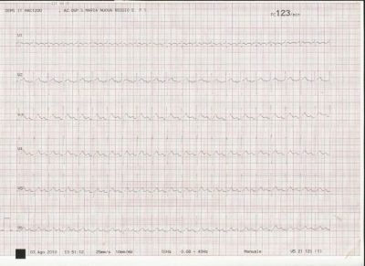 ECG, electrocardiograma, corazón, electrodos
