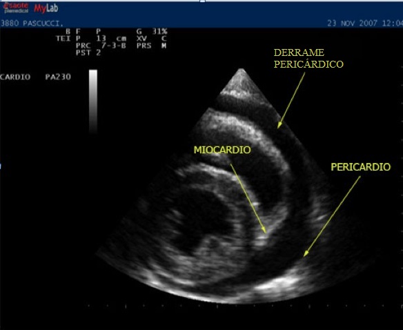 ecocardiograma, pericarditis