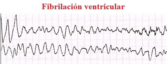 fibrilación ventricular, ECG