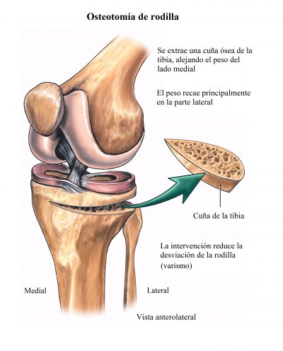 osteotomía de rodilla, cirugía