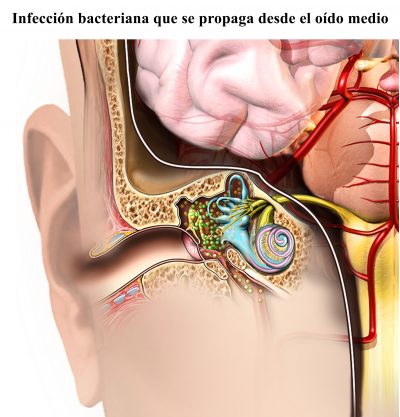 infección bacteriana, oído, otitis media