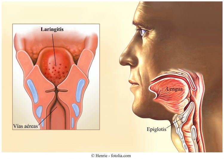 laringitis, inflamación