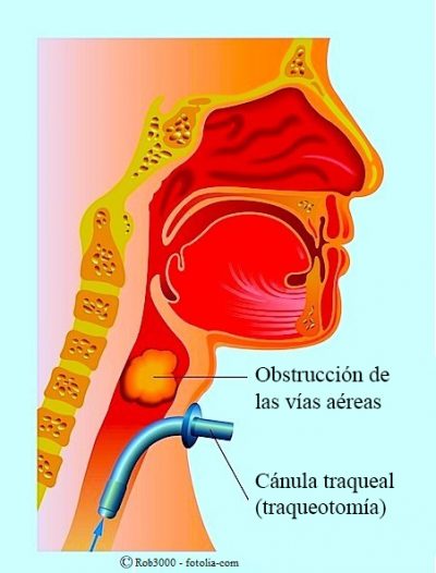 traqueotomía, obstrucción de las vías respiratorias