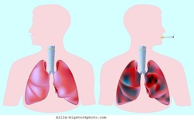 tumor pulmonar, metástasis