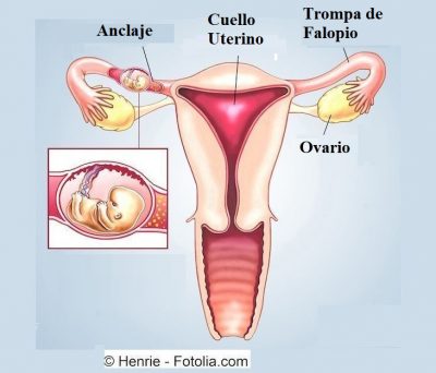 embarazo extrauterino, útero, ovarios, feto