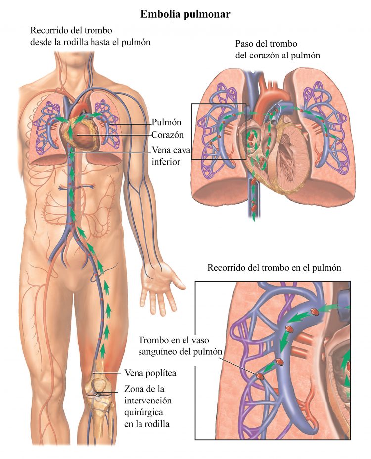 embolia pulmonar, trombosis, émbolo - © alamy.com