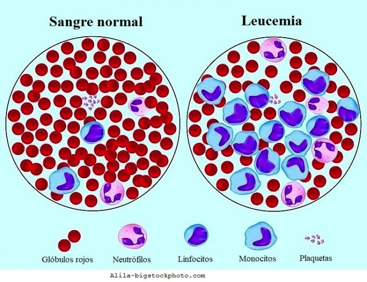células de la sangre, leucemia