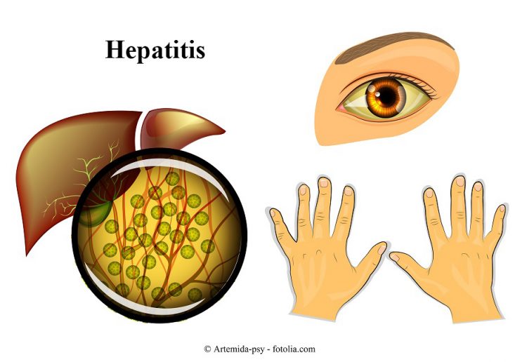 hepatitis, hígado, ictericia