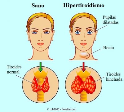 hipertiroidismo, bocio, tiroides