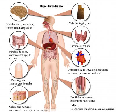 hipertiroidismo, síntomas