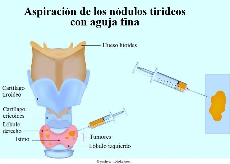 Como se opera un nodulo tiroideo