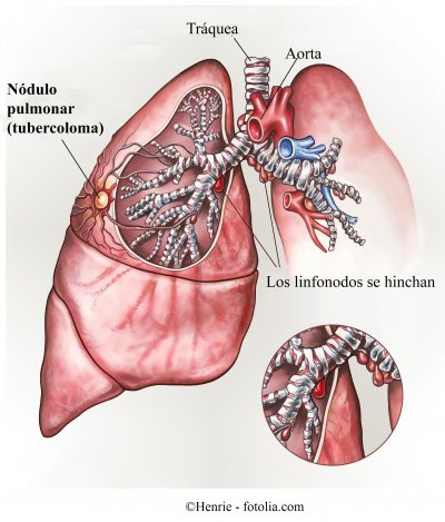 nódulo pulmonar, tuberculoma