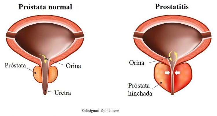 Prostatitis - A Prosztatagyulladás Okai, Tünetei és Kezelése