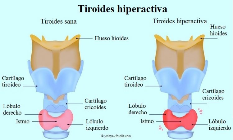 Crucíferas y tiroides