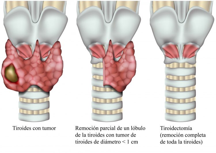 tiroidectomía, cirugía, tiroides