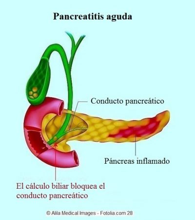 pancreatitis, páncreas, inflamación, síntomas