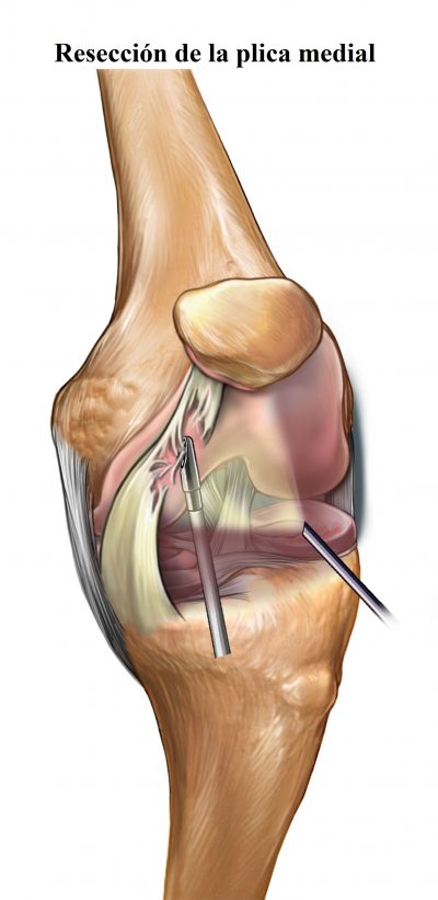 resección quirúrgica de la plica medial de la rodilla