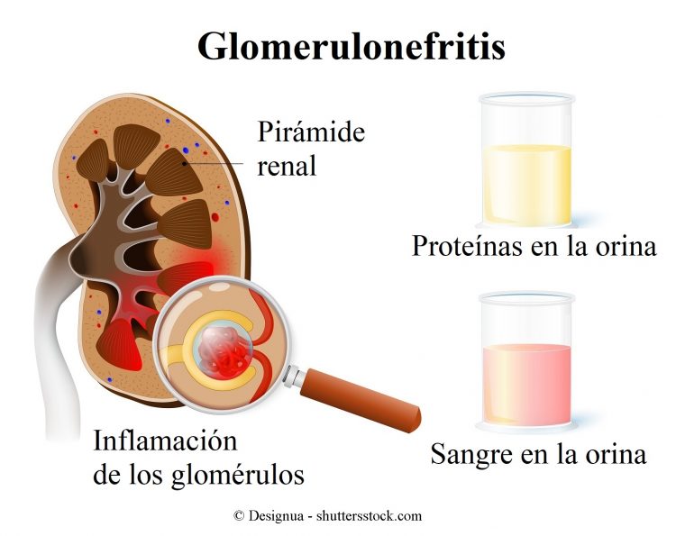 glomerulonefritis